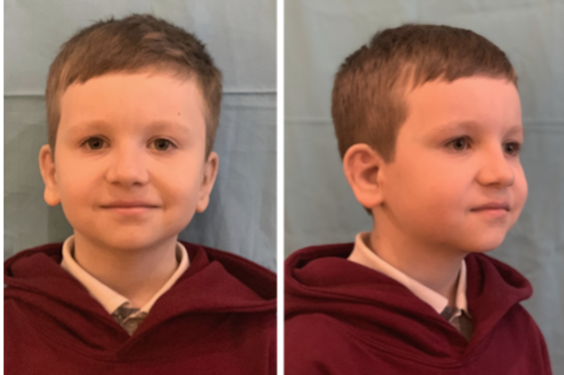 Both Ears: Before & After