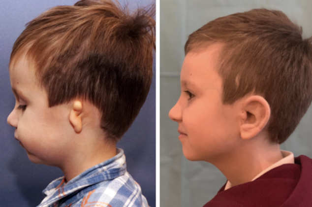 Both Ears: Before & After - BEFORE & AFTER Russian boy 5yrs. after right and left combined ear reconstruction