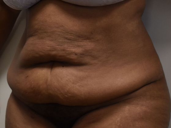 Tummy Tuck (Abdominoplasty): Case 344 - Before