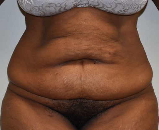 Tummy Tuck (Abdominoplasty): Case 344 - Before