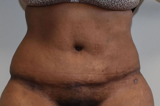 Tummy Tuck (Abdominoplasty): Case 344 - After