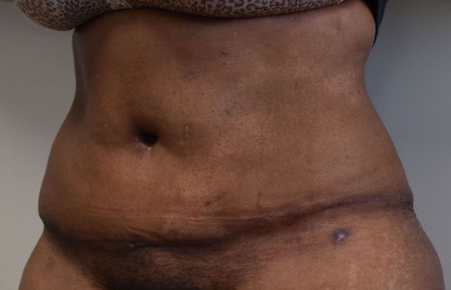 Tummy Tuck (Abdominoplasty): Case 344 - After