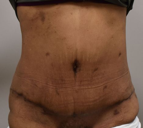 Tummy Tuck (Abdominoplasty): Case 345 - After