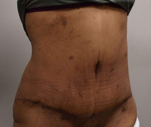 Massive Weight Loss : Case 102 - After