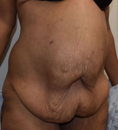 Massive Weight Loss : Case 102 - Before