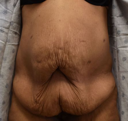 Massive Weight Loss : Case 102 - Before