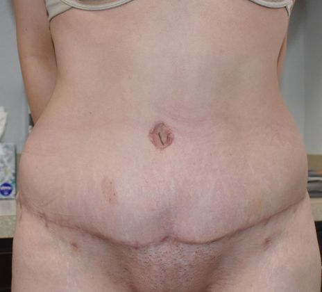 Tummy Tuck (Abdominoplasty): Case 305 - After