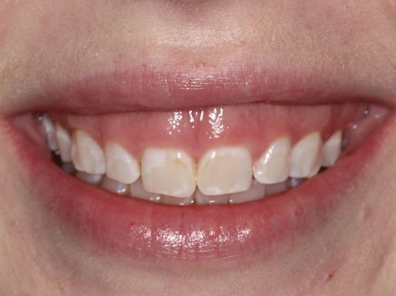 Smile Makeover: Case 1 - Gummy Smile in Arvada, CO - Before