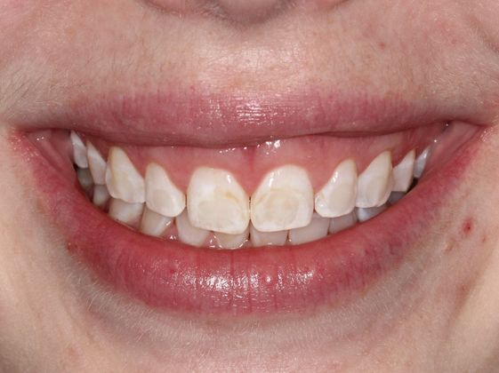 Smile Makeover: Case 1 - Gummy Smile in Arvada, CO - After