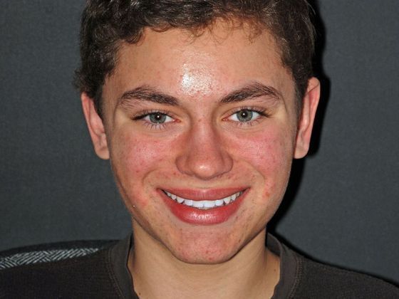 Cosmetic Bonding Spencer S. - After