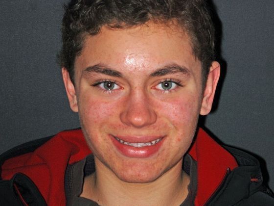 Cosmetic Bonding Spencer S. - Before