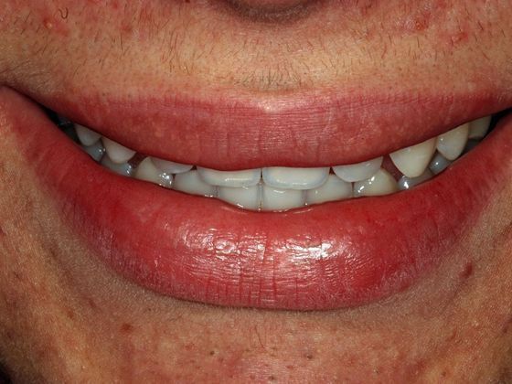 Cosmetic Bonding: Spencer S. - Before