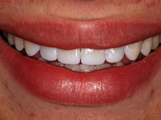 Cosmetic Bonding: Spencer S. - After