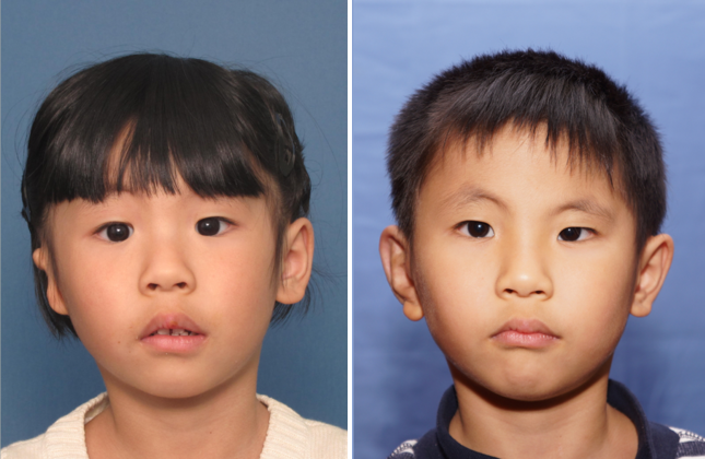 Single Ear: Befor & After - A 5 year old boy who came from China for reconstruction of his right ear.
