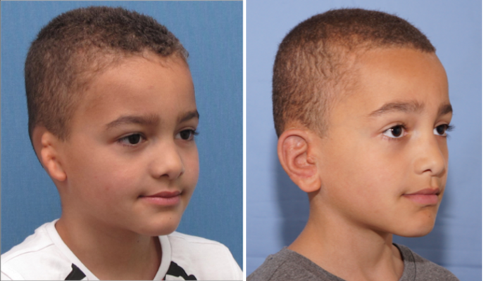 Single Ear: Befor & After - A 6 year old boy from Holland seen before & 2 years after surgery.