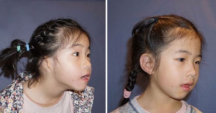 Single Ear: Befor & After
