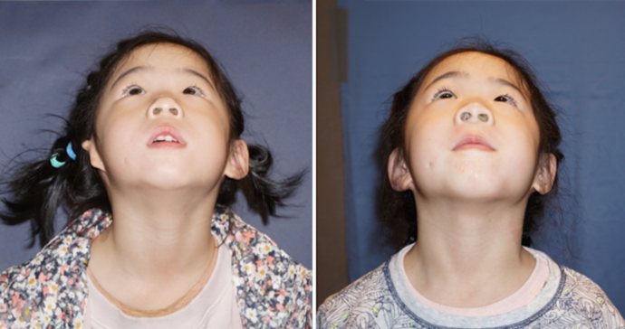 Single Ear: Befor & After - A 4 year old girl from China before & 1 year after a single Medpor surgery.