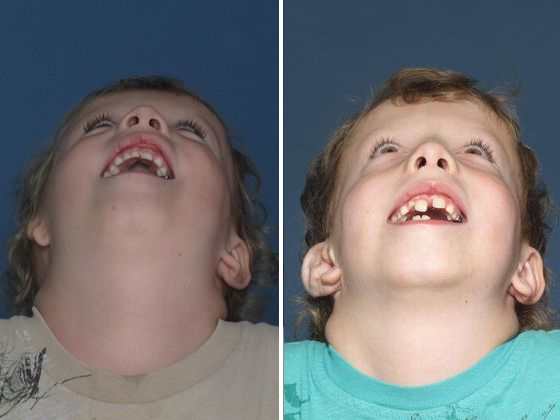Single Ear: Befor & After - 4 year old boy seen before & 2 years after single Medpor surgery.