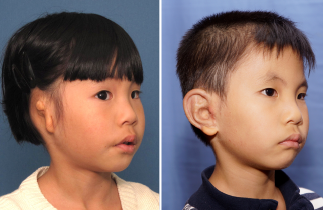 Single Ear: Befor & After - He is seen 2 years following a single outpatient Medpor surgery.