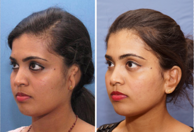 Single Ear: Befor & After - Before