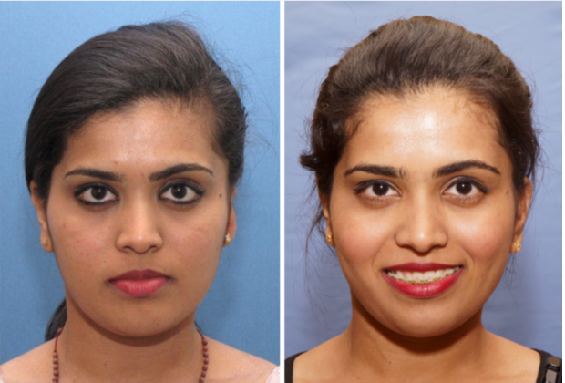 Single Ear: Befor & After - Before