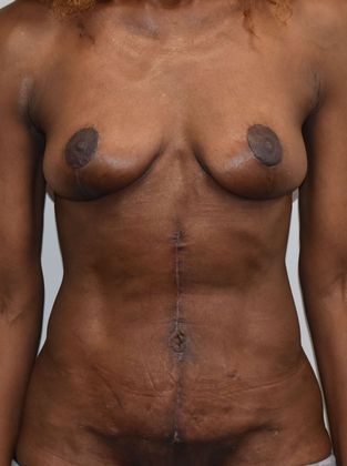 Mommy Makeover Case 229 - After