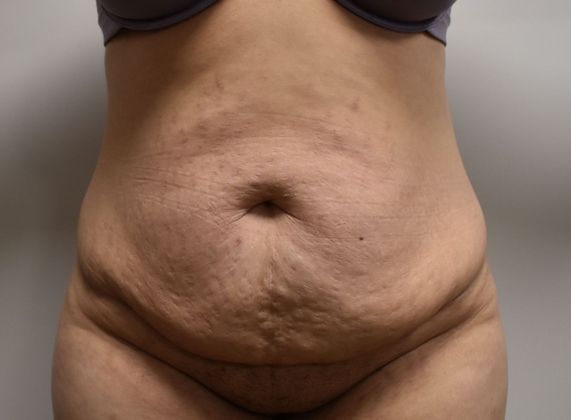 Tummy Tuck (Abdominoplasty): Case 346 - Before