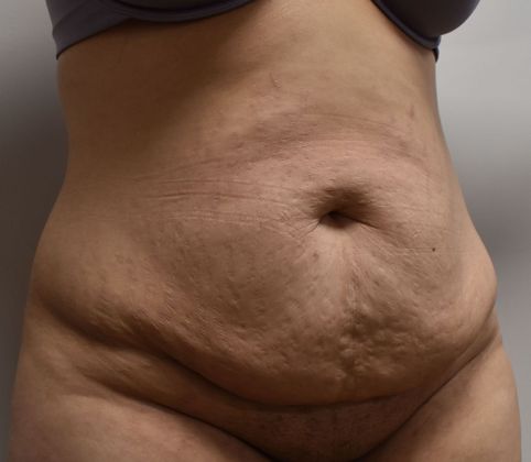 Tummy Tuck (Abdominoplasty): Case 346 - Before