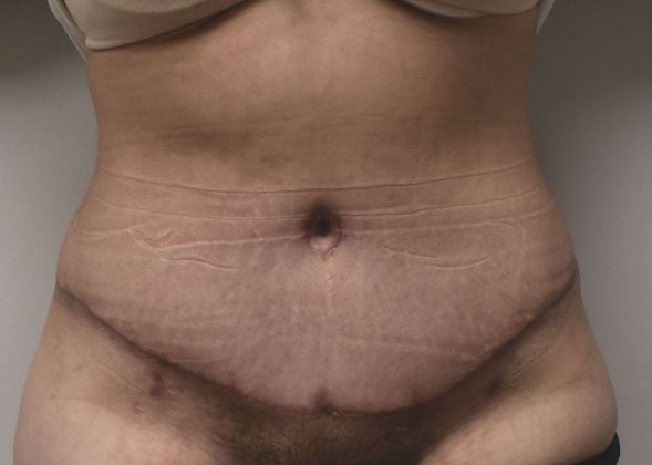 Tummy Tuck (Abdominoplasty): Case 346 - After