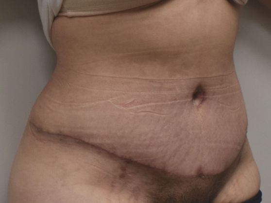 Tummy Tuck (Abdominoplasty): Case 346 - After