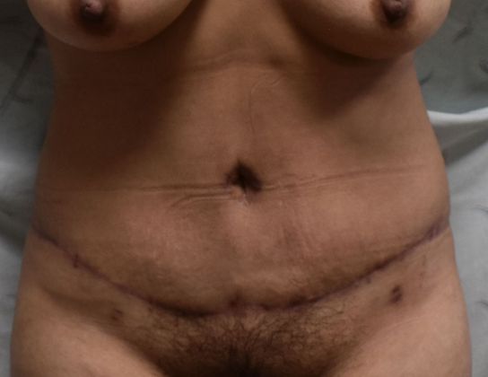 Tummy Tuck (Abdominoplasty): Case 347 - After