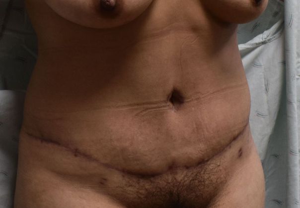 Tummy Tuck (Abdominoplasty): Case 347 - After