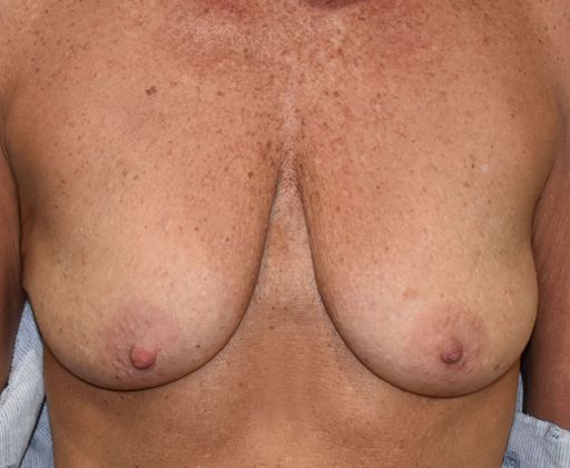 Breast Augmentation w/ Lift Case 424 - Before