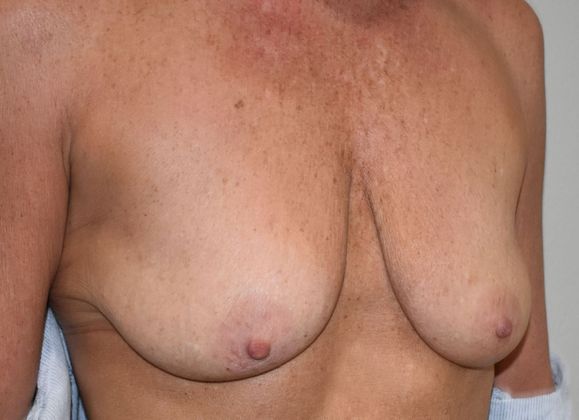 Breast Augmentation w/ Lift: Case 424 - Before