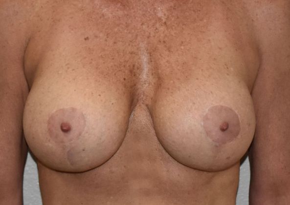 Breast Augmentation w/ Lift Case 424 - After