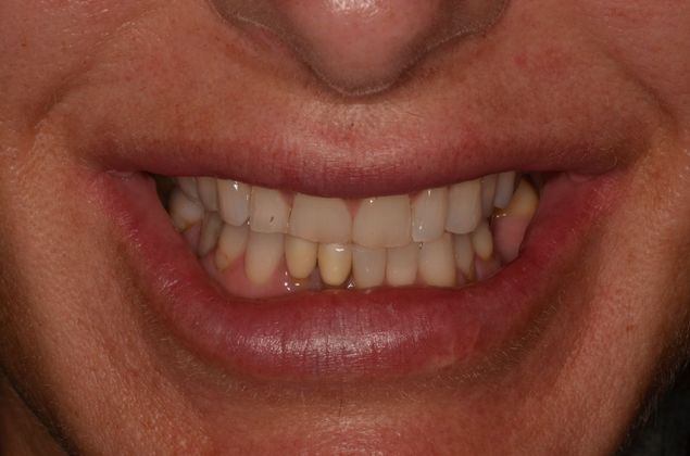 Porcelain Veneers: Case 28 - Before