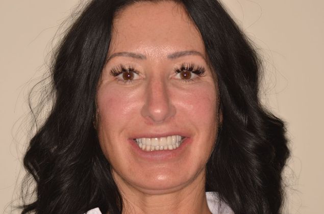 Porcelain Veneers: Case 28 - After Porcelain veneers and two crowns