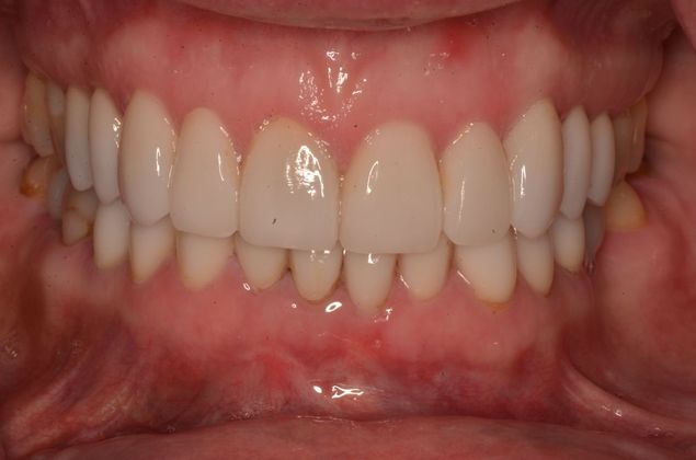Porcelain Veneers: Case 28 - After
