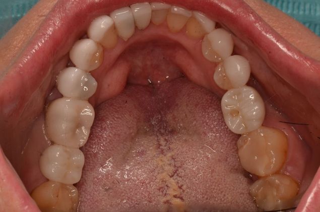 Porcelain Veneers: Case 28 - After Porcelain veneers and two crowns