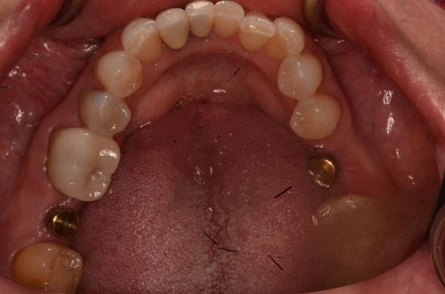 Dental Implants Case 55 - Before