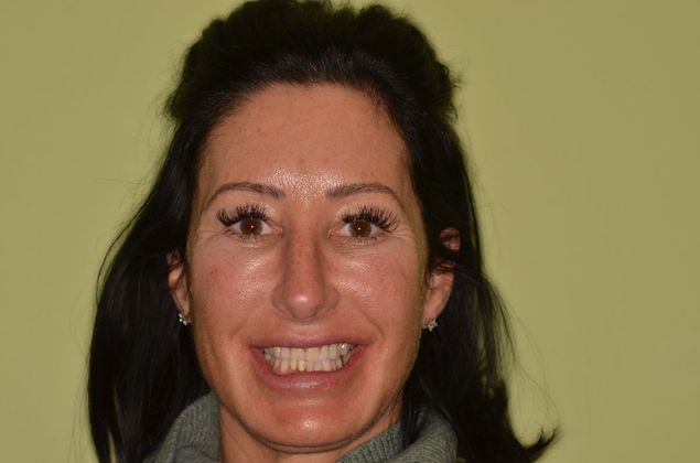 Smile Design: Case 12 - Before invisalign, crowns, porcelain veneers and implants