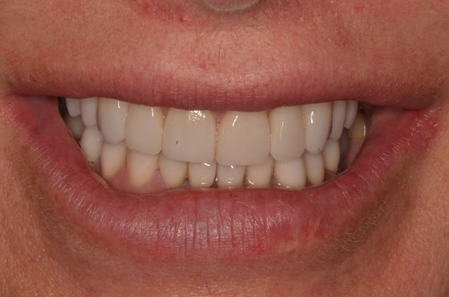 Smile Design: Case 12 - After