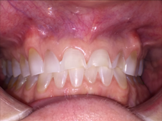 Smile Makeovers: Case 10 - Before