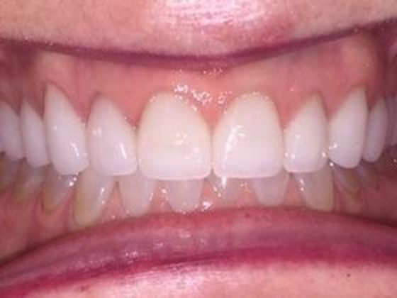 Smile Makeovers: Case 10 - After