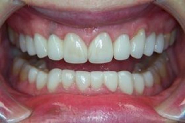 Smile Makeovers: Case 23 - After