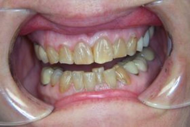 Smile Makeovers Case 15 - Before