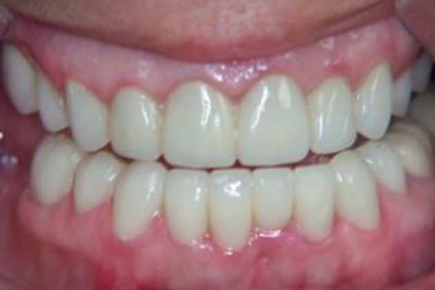 Chipped Tooth Repair - Nashville, TN - Gulch Dental Studio