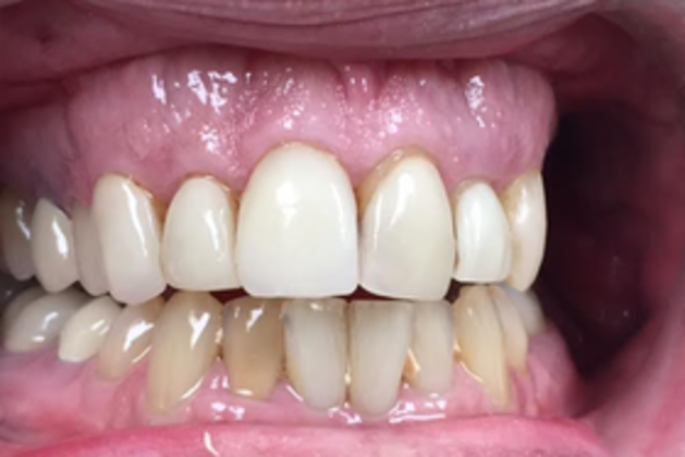 Smile Makeovers: Case 14 - Before