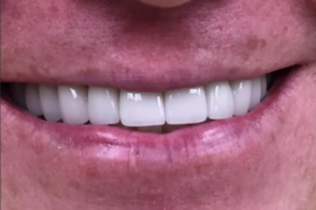 Smile Makeovers: Case 14 - After