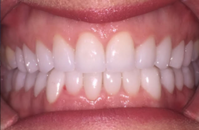 Smile Makeovers: Case 17 - After